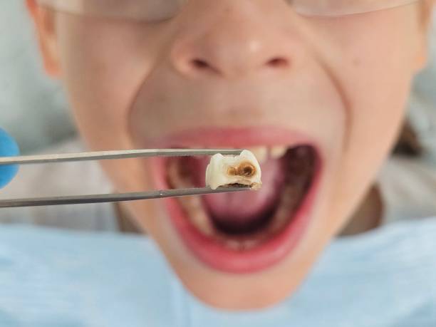 Best Emergency Treatment for Oral Infections in Highlands, CA