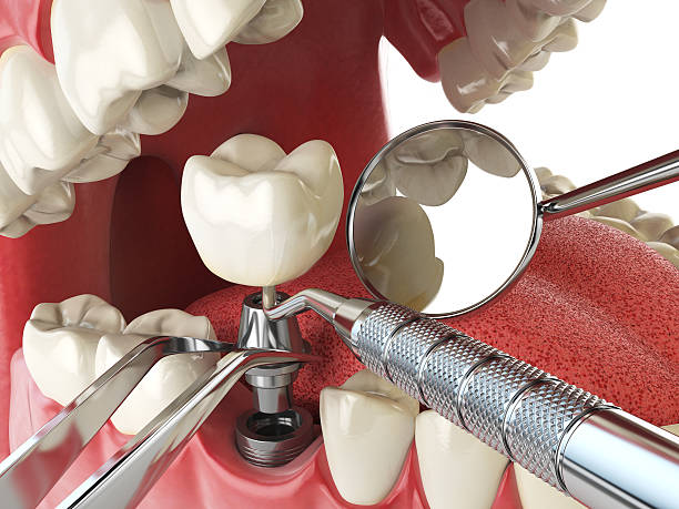 Best Emergency Dental Care for Sports Injuries in Highlands, CA